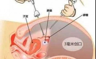 宫外孕流产流程（宫外孕做流产怎么做的）