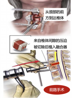 颈椎手术流程（颈椎手术流程视频）-第3张图片-祥安律法网