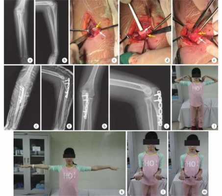 手肘骨折手术流程（手肘关节骨折手术费用）-第3张图片-祥安律法网