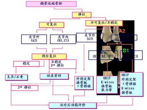 骨折评级流程（骨折评级流程及标准）-第3张图片-祥安律法网