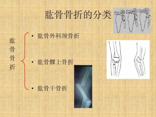 肱骨骨折流程（肱骨骨折的恢复过程）-第1张图片-祥安律法网