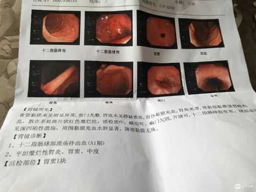 胃出血看病流程（胃出血看病流程是什么）-第3张图片-祥安律法网