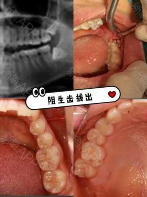 宁波拔智齿报销流程（宁波拔智齿能报医保吗）-第3张图片-祥安律法网