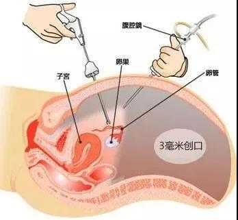 宫外孕流产流程（宫外孕做流产怎么做的）-第1张图片-祥安律法网